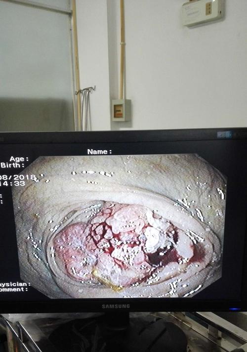 腊肠犬食管狭窄的表现、治疗与预防