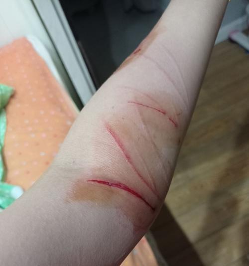 被猫抓伤后应如何处理伤口？
