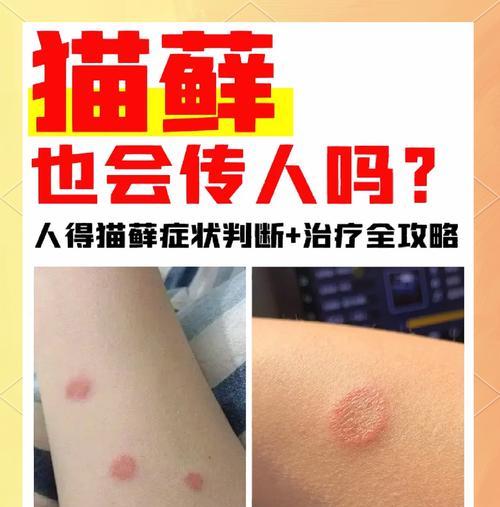猫癣对人有生命危险吗？如何预防和治疗？
