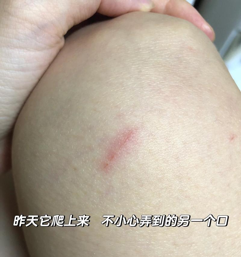 被猫抓伤后需要立即打针吗？多久内打针是安全的？