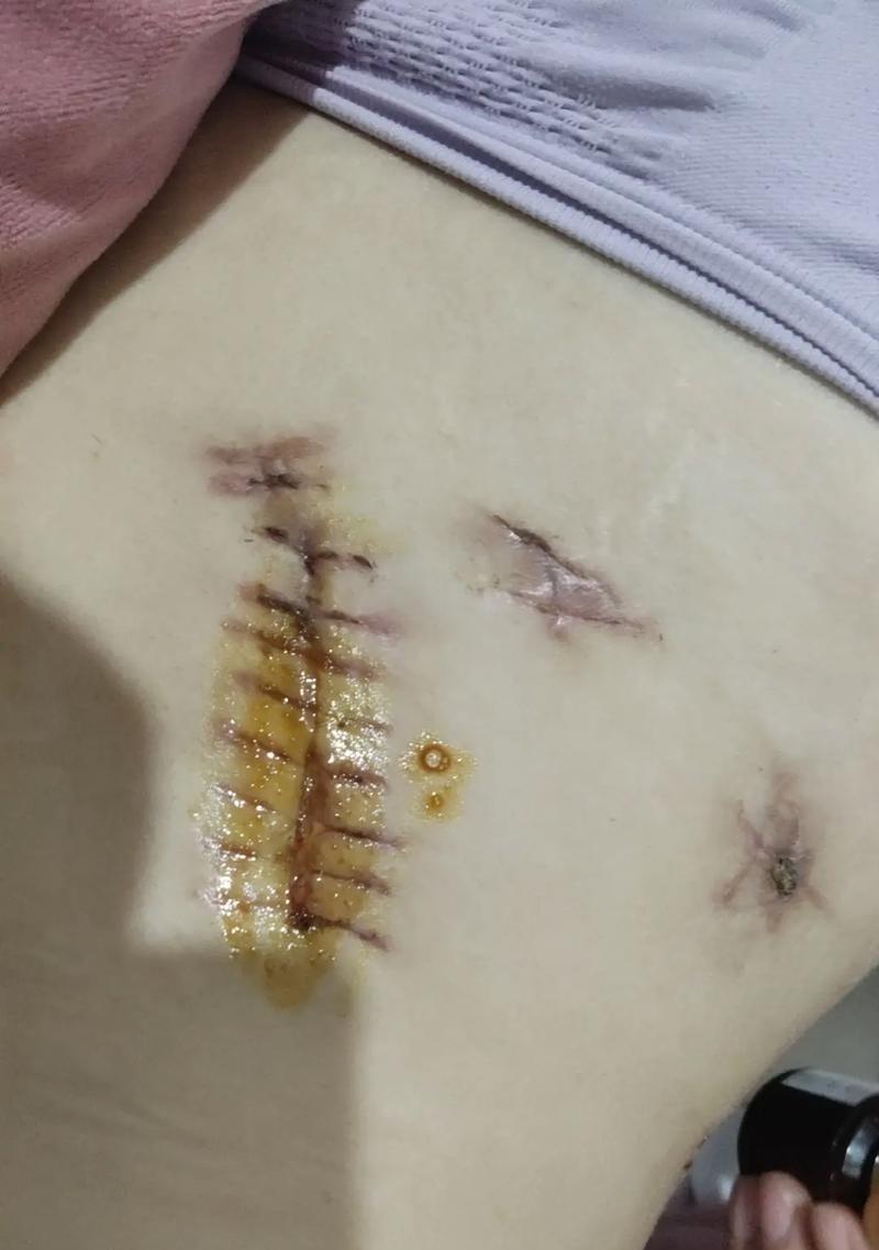 手术后多久能恢复？